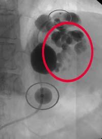 胃静脈瘤に硬化剤を注入、画像に硬化剤が黒く写っている写真
