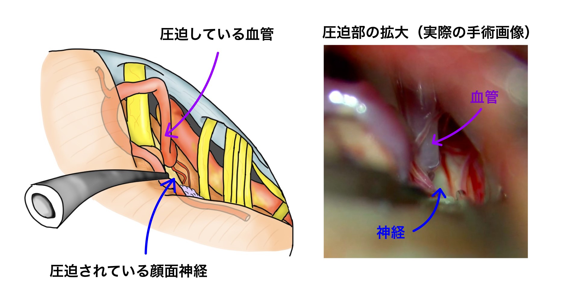 圧迫されている顔面神経