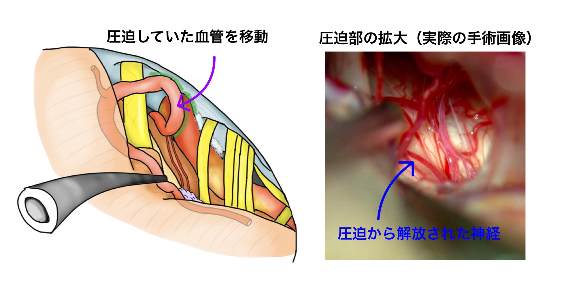 圧迫していた血管を移動