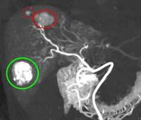 血管造影下CTで撮影した肝がんの様子の写真