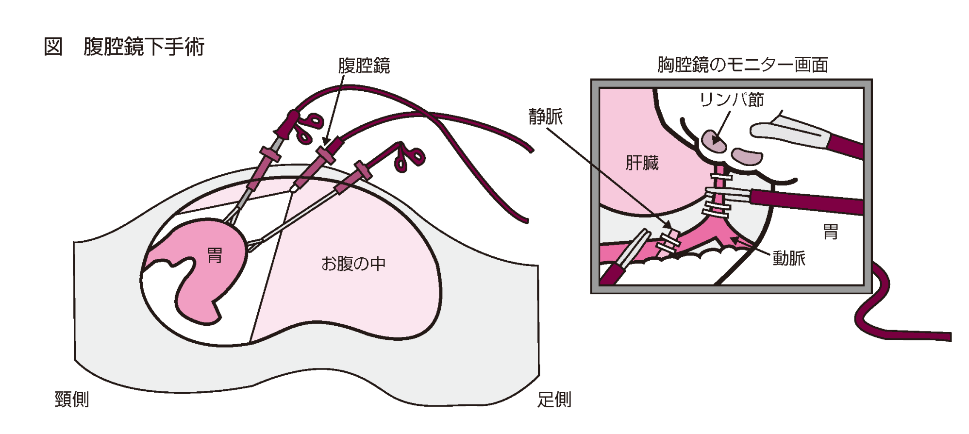 腹腔鏡下手術のイラスト図