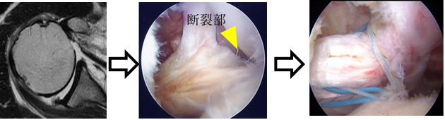 肩甲下筋断裂修復術