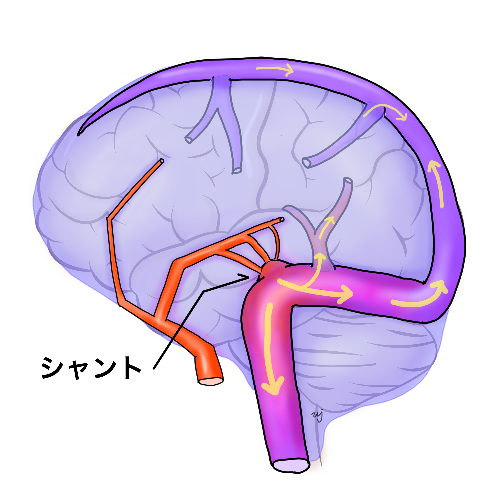 シャント