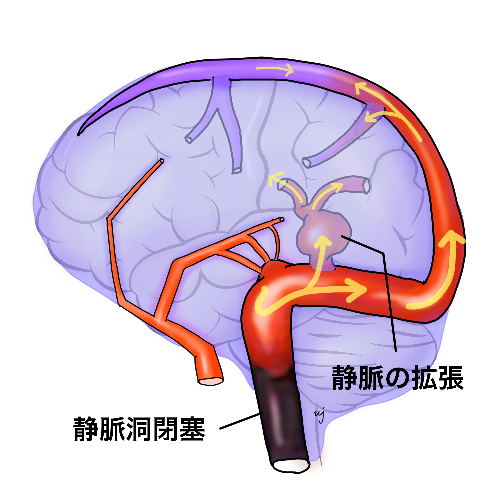 静脈洞閉塞