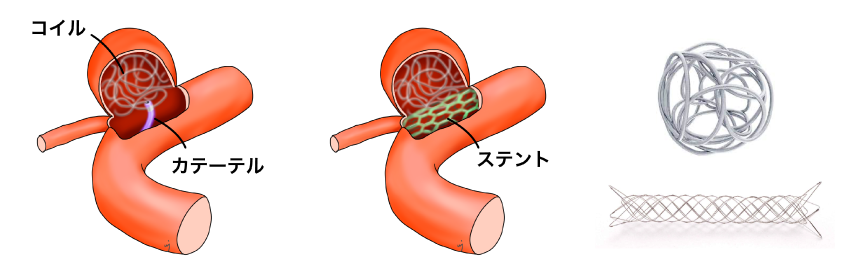 コイル塞栓術の模式図