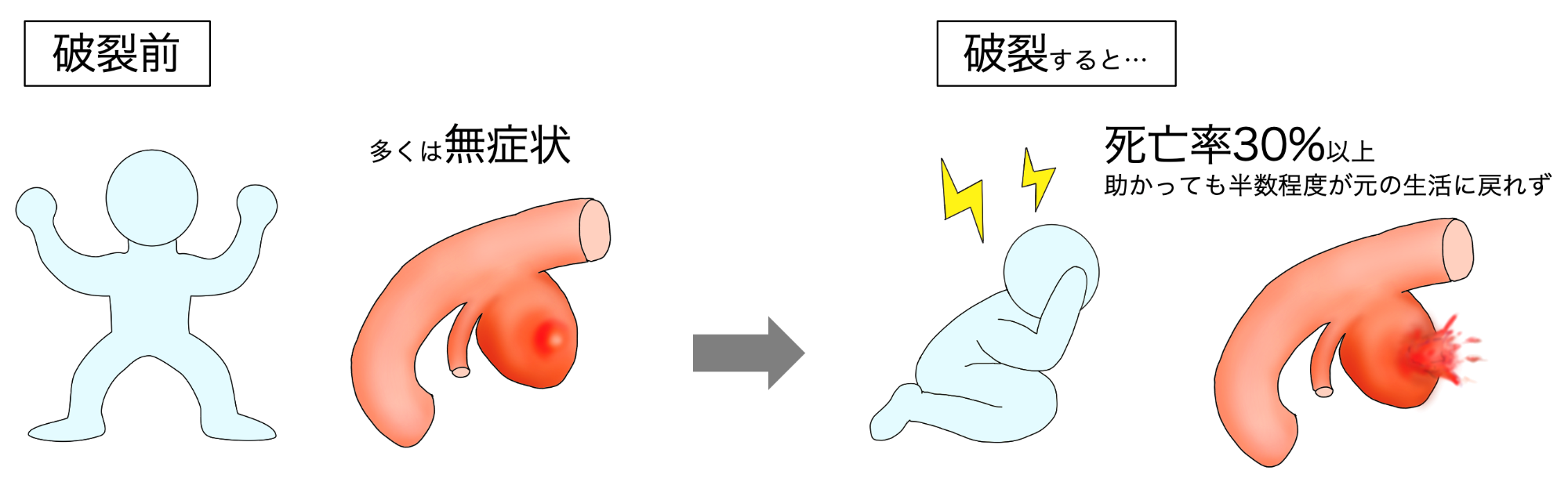 脳動脈瘤が破裂する前と後をイラストで表したもの