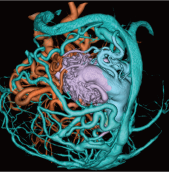 3D fusion imagingによる術前の画像解析
