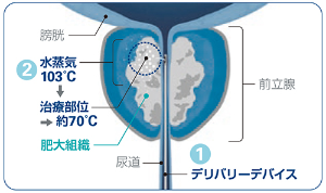 治療の流れ1と2を表した図