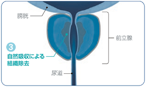 治療の流れ3を表した図