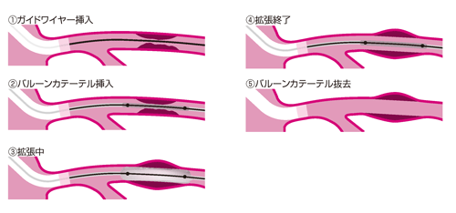 バルーン治療
