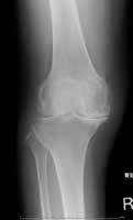 手術前の膝関節のレントゲン