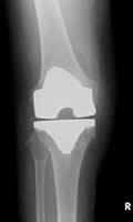 手術後の膝関節のレントゲン