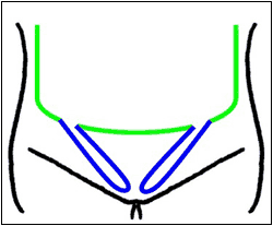女性の腹膜の一部が袋状に飛び出している様子のイラスト