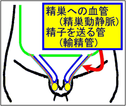 男性の腹膜の一部が袋状に飛び出している様子のイラスト