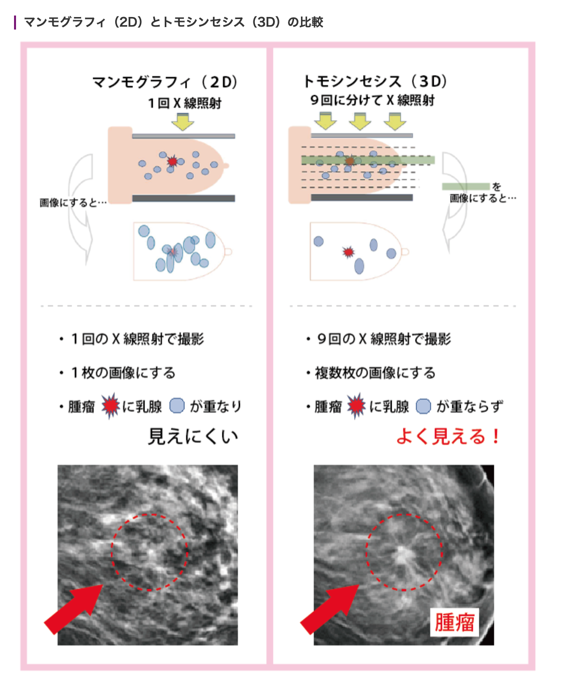 2Dと3Dマンモグラフィの比較
