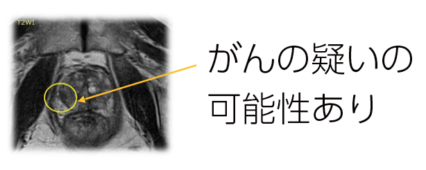 前立腺の検査でがんが見つかった画像