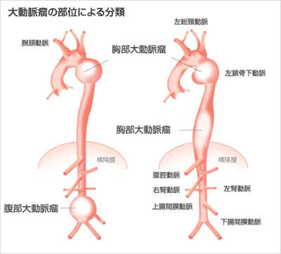 大動脈瘤の部位による分類