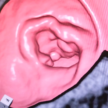 大腸全体のCT画像