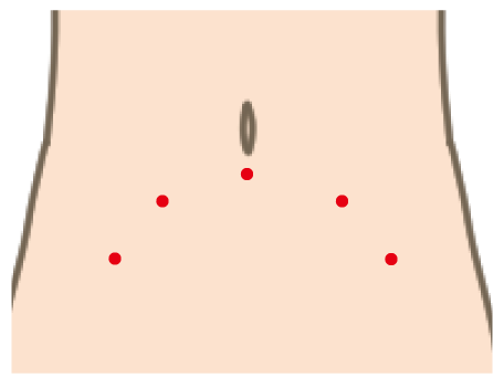 腹部のダビンチ手術の傷口イメージ図