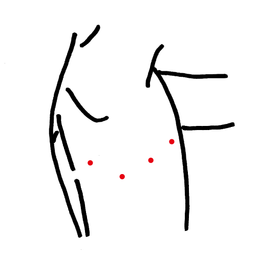 胸のダビンチ手術の傷口イメージ図