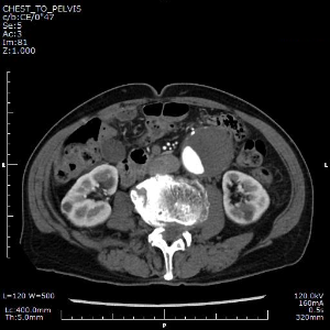 腹部CT画像