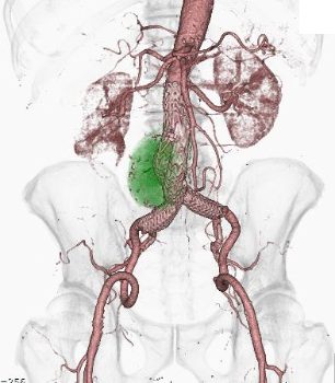 腹部血管VR画像