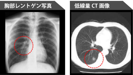 胸部レントゲン写真と低線量CT画像