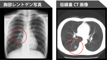 レントゲン＆CTの肺画像