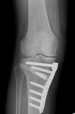手術後の右ひざのレントゲン映像