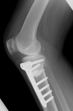 手術後の右ひざのレントゲン映像