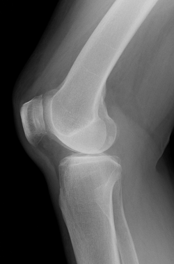 手術前の右ひざのレントゲン映像