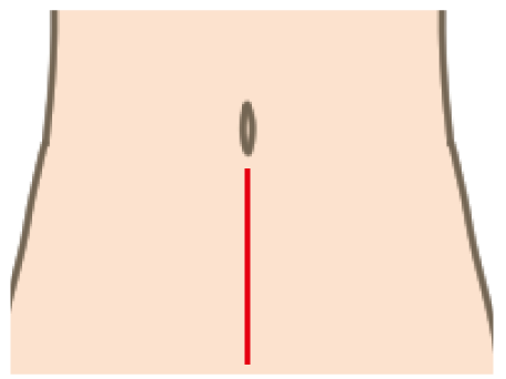 開腹手術の傷口イメージ図