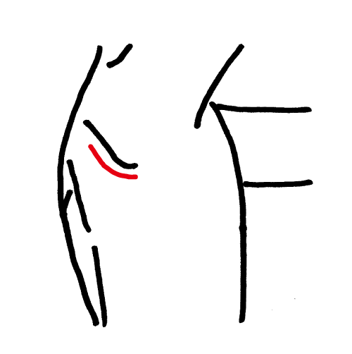 開胸手術の傷口イメージ図