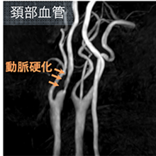 頸部血管の動脈硬化