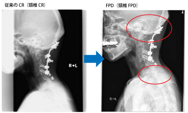 頸椎の画像の比較