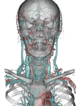 血管VR画像頸部から脳動静脈