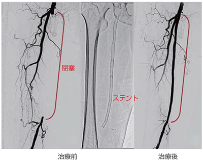 血管内治療前後の血管造影像
