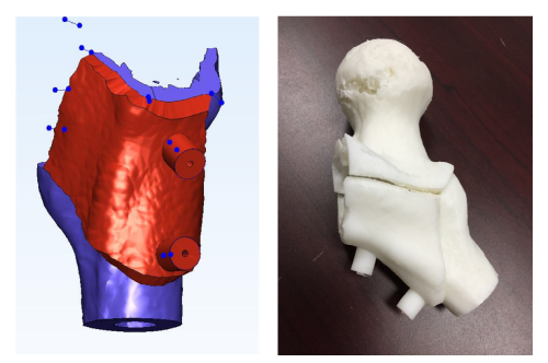 3Dプリンターで作成した大腿骨頭回転骨切り術用の術中支援器具