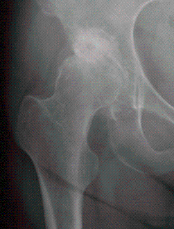 変形性股関節症の単純X線写真