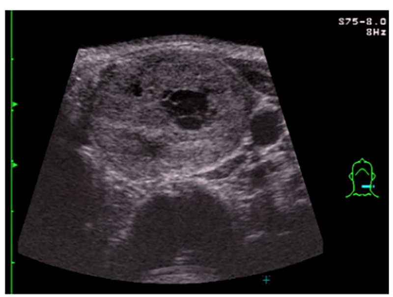 甲状腺エコー検査の一例