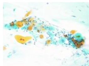 喀痰検査で現れたがん細胞