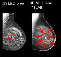 3Dマンモグラフィの画像