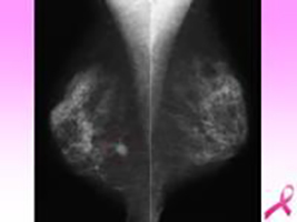 3Dマンモグラフィの画像