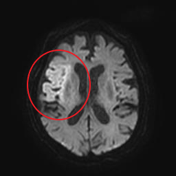 頭部のMRI脳梗塞の画像