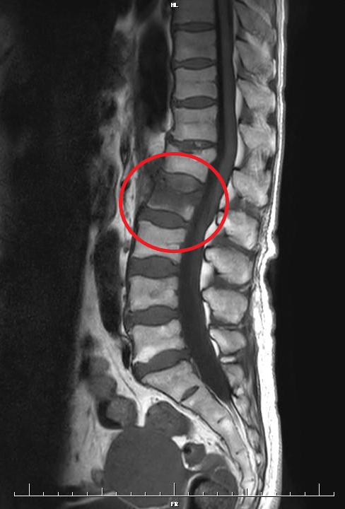 腰椎のMRI画像