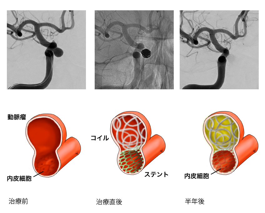 ステント併用コイル塞栓術の一例