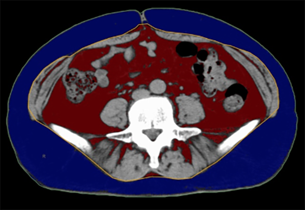 内臓脂肪測定のCT結果