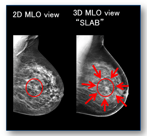 マンモグラフィ2Dと3Dの画像の比較