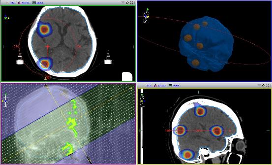 新治療装置の脳のピンポイント照射で撮った脳の断面画像