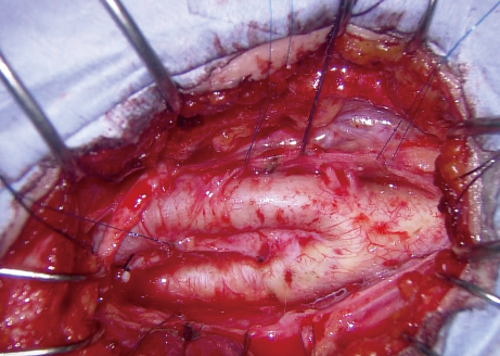 頸動脈内膜剥離術の一例